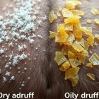 Łupież suchy czy tłusty: jak rozpoznać i dobrać skuteczną pielęgnację skóry głowy