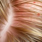 Swędząca skóra głowy: najczęstsze przyczyny i skuteczne sposoby łagodzenia świądu